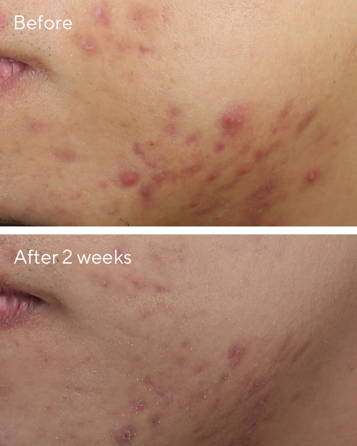 Deep Relief Blemish Treatment - Image 6